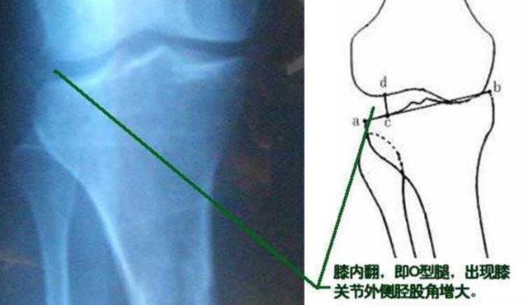 詹姆斯也是O型腿为什么他膝关节不疼而我打篮球就腿痛呢