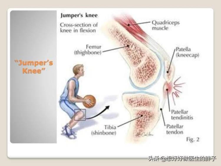 篮球常见的运动损伤的预防措施有哪些「篮球运动中常见的运动损伤有哪些如何预防和治疗医生告诉您」