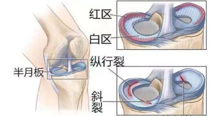 韦德20岁就摘除了半月板为什么成就还这么高答案有点意外