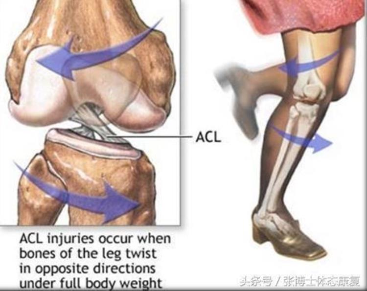 前交叉韧带重建术后康复评内容和康复流程,前交叉韧带重建后伤口如何处理