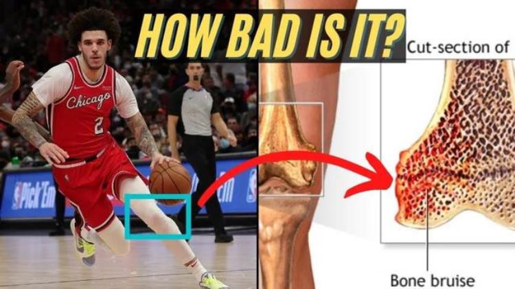 nba致命伤病「再见NBA致命手术0复出概率天妒英才啊」