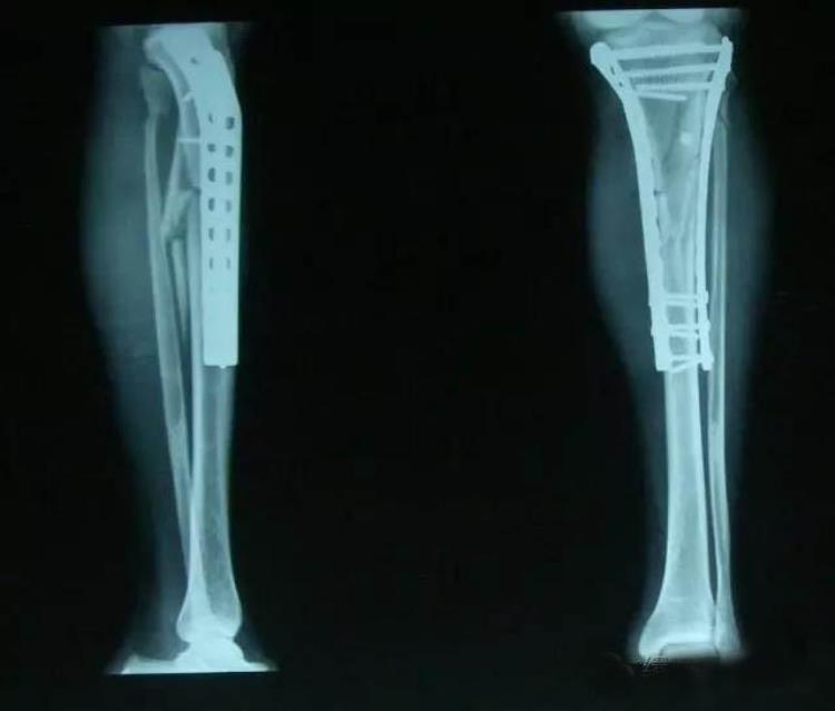 某人打篮球左胫骨骨折「NBA篮球赛场某球星小腿骨折严重变形确诊胫腓骨骨折」