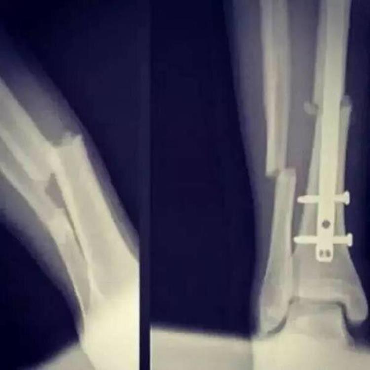球星手术后疤痕「手术伤疤看NBA球星多不易科比疤痕超20厘米乔治断腿植入钢钉」