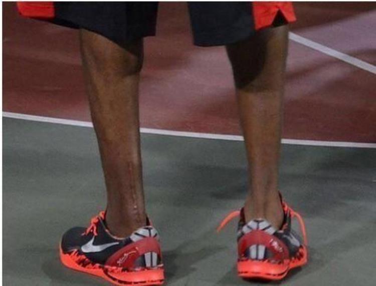 手术伤疤看NBA球星多不易科比疤痕超20厘米乔治断腿植入钢钉