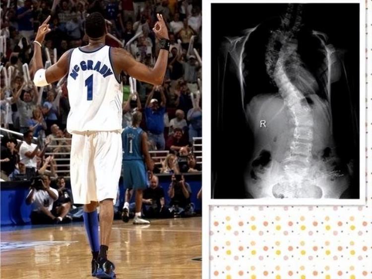 这些球员身体上有缺陷韦德进NBA前摘除半月板姚明左耳失聪