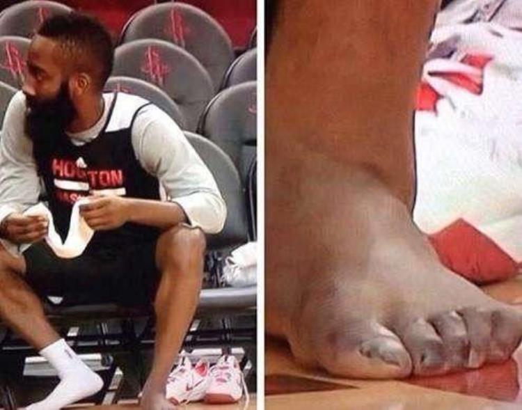 为什么nba球员的脚趾会变形「NBA球员脚趾为何这么多畸形他们突破时球鞋都快撑破了」
