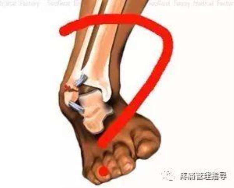 nba球员脚踝扭伤怎么治疗「NBA球星脚踝扭伤的处理方法从此不再怕脚扭伤」