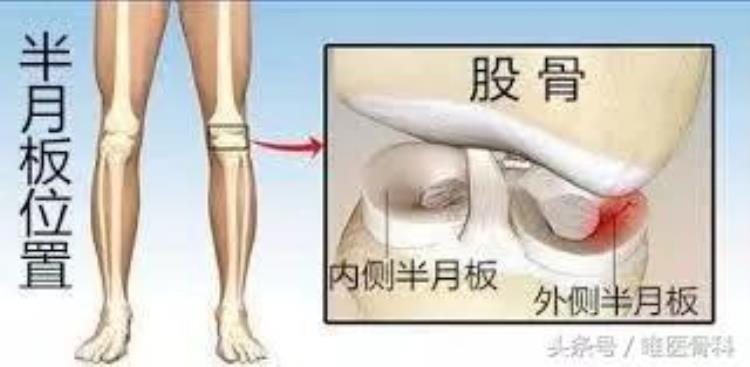 半月板损伤nba球星「半月板的伤痛让NBA球星备受折磨骨科医生揭开治疗真相」