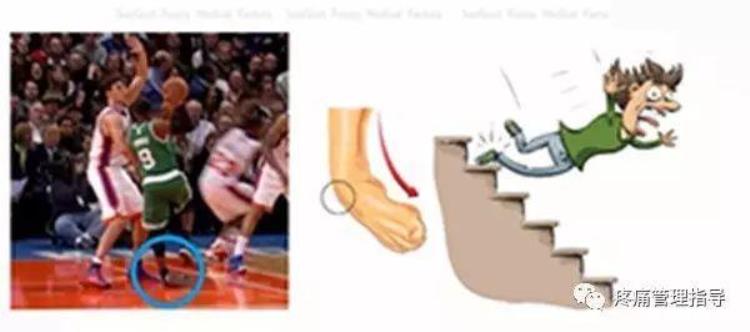 nba球员脚踝扭伤怎么治疗「NBA球星脚踝扭伤的处理方法从此不再怕脚扭伤」