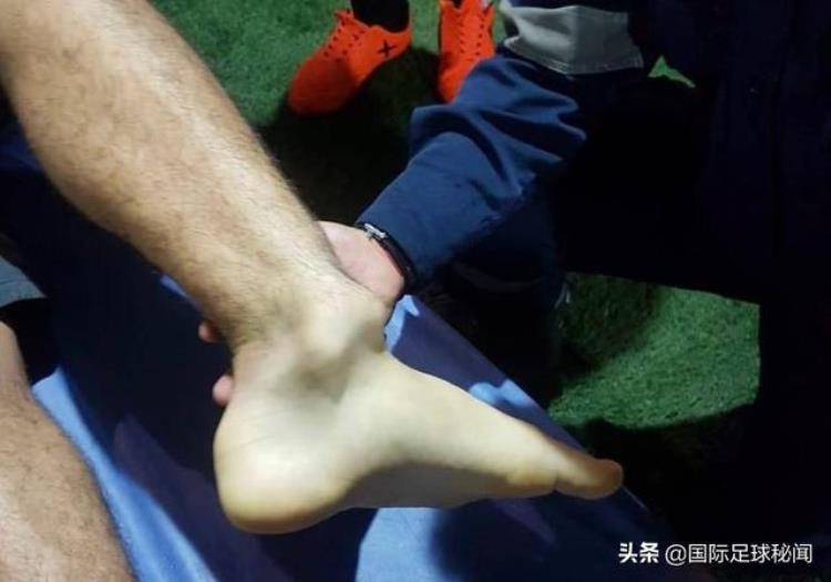 转危为安世预赛一球员铲弯自己的脚腕医生神操作瞬间复位