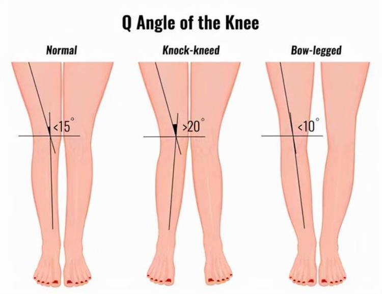 膝前部疼痛与Q角度一些常用的练习方法