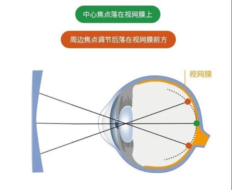 暑假近视防控福利配这副眼镜可防控近视度数涨了无忧退换