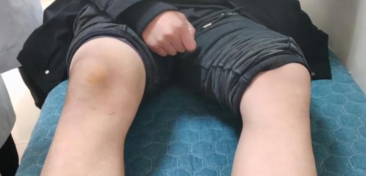 膝盖伸直用力时疼痛怎么回事